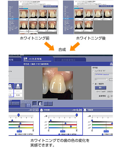 ホワイトニングでの歯の色の変化を実感できます。